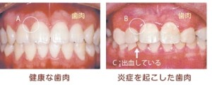 歯茎 血 が 出る