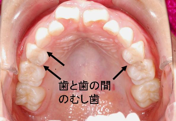 乳歯のむし歯の特徴 落合歯科医院