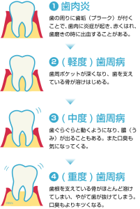 血 が 出る 歯茎