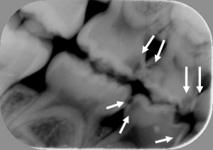乳歯 レントゲン